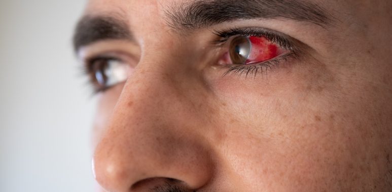 Some Causes of Broken Blood Vessel In The Eye